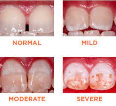 Fluorosis Facts Information Parents Caregivers Healthychildren Org