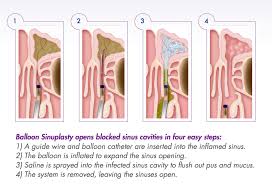 Image result for Eustachian Tube Dysfunction