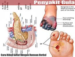 Maybe you would like to learn more about one of these? Audio For Car Sport Cara Tepat Mengobati Penyakit Gula Dengan Ramuan Herbal