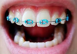 If you're going to be dorothy from the wizard of oz, you need to have ruby slippers and pigtails. Family Care Dental Fake Braces And Its Consequences