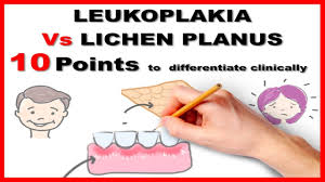 How to get rid of blisters on tongue fast. Leukoplakia Vs Lichen Planus 10 Points To Differentiate Clinically Youtube