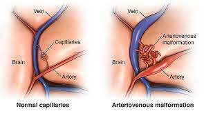 It may not be related to aneurysm or surgery but i would want to rule out hydrocephalus. Cerebral Aneurysm Cedars Sinai
