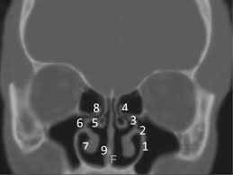Computed Tomography Anatomy Of The Paranasal Sinuses And Anatomical Variants Of Clinical Relevants In Nigerian Adults Sciencedirect