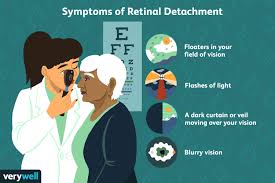 As with other retinal surgeries, you will be required to abstain from eating or drinking anything for between two and eight hours before recover from surgery. Detached Retina Signs Symptoms And Complications