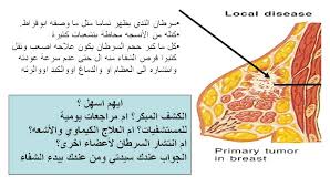 القضاء على سرطان الثدي Dr Mohammed E Zakaria Clinic