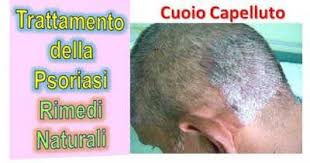 Chi Altro Vuole Alleviare I Sintomi Di Psoriasi Del Cuoio Capelluto In Pochi Giorni Dopo Questi Suggerimenti Psoriasi In Testa Psoriasi Rimedi Rimedi Naturali