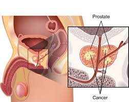 Breast cancer is the second most common cancer found in women — after skin cancer — but that doesn't mean men aren't at risk as well. Prostate Cancer