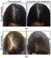 About 39 % had been on the treatment 6 months and 60 % had been on treatment a year or more. Combination Therapy To Treat Asian Female Pattern Hair Loss