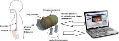 Image result for Wireless Capsule Endoscopy