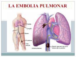 La embolia pulmonar suele ser causada por coágulos sanguíneos que viajan a los pulmones desde las piernas. Embolismo Pulmonar Ecured