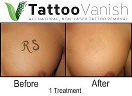 Laser tattoo removal is great for those unfortunate times you break up with the one (whose name you tattooed on your arm), realize butterflies don't belong but how does a laser actually remove the tattoo? Tattoo Vanish The Best All Natural Non Laser Tattoo Removal Fast Eyebrow Tattoo Removal Near Me Tattoo Removal Cream