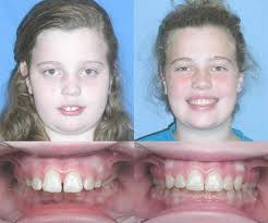 The term overbite does not refer to a specific condition, nor is it a form of malocclusion. Overbite Before And After Braces Top Pictures More 2021 Bracesboss