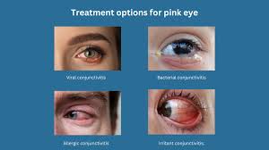 Image result for Viral Conjunctivitis