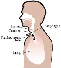 Image result for Tracheostomy