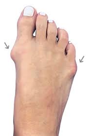 Try these bunion exercises for before and after surgery, follow easy instructions & learn how to perform movements safely and effectively. Bunion Pictures Before And After Bunion Surgery