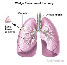 In the early stages, people often do not see any signs of lung cancer; Non Small Cell Lung Cancer Hematology Oncology Associates Of Cny