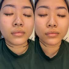 Beautiful subtle chin filler to help elongate the face and give a more  feminine feel ✨ (We also treated the masseter muscles to help slim the  face- results to come in 2-4