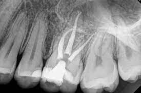 Core Buildup Procedure After Root Canal | Midtown Endodontist NYC