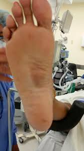 Pin On Plantar Fibromastosis