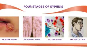 Image result for Syphilis