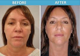 For me, by the end of the week and before the end of the week have the same meaning. Weekend Mini Face Lift Before After Photos Center For Cosmetic Surgery In San Diego