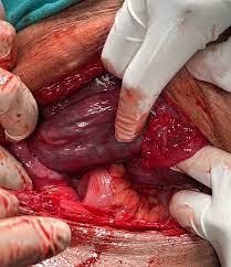Uterus didelphys pictures