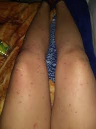 Granitos Con Liquido Que Pican En Mis Piernas Dermatologo Net