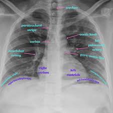 Image result for Chest XRay
