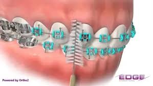 Your toothbrush will become your best friend during your orthodontic treatment. Do I Have To Brush Immediately After Eating With Braces Quora