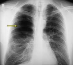 Die abkürzung copd steht für den englischen ausdruck chronic obstructive pulmonary disease, der entsprechende deutsche begriff ist auch finden umbauprozesse der lunge bei der copd statt. Lungenemphysem Universitatsklinikum Freiburg