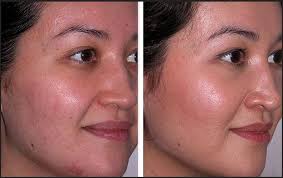 Carbon Peel Removal in Chandigarh