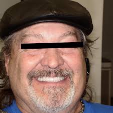 A nice esthetic and functional transformation utilizing a maxillary  complete denture and a mandibular implant overdenture. Neodent gm helix  implants were placed immediately into the canine sockets and left to heal  for