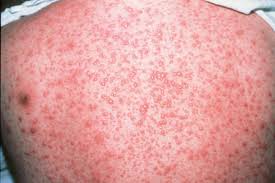 Primary infection usually results in varicella (chickenpox), after which vzv becomes latent in ganglionic neurons along the entire neuraxis. Varicella Zoster Virus Vzv Images Hiv