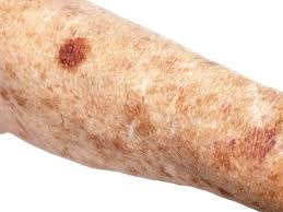 Image result for liver spots on legs