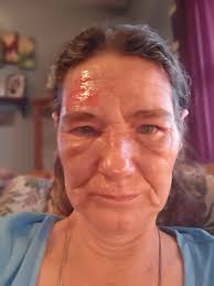 I'm a walking miracle burn survivor shares healing journey