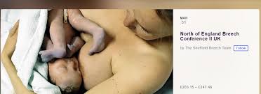 Image result for Breech Delivery