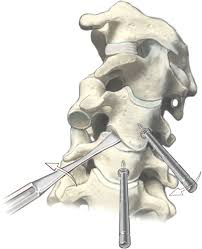 Treatments that may be performed at home to relieve lumbar facet pain include: Reduction Of Locked Cervical Facets Manual Anterior Open Posterior Open Springerlink