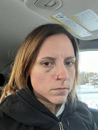 Have you ever been injured by your Heeler?