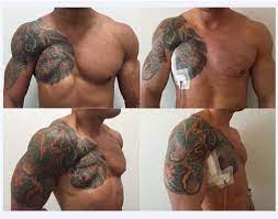 Treatment may require the coordinated efforts of a team of specialists. Pdf Poland S Syndrome Treatment With Customized Implant A Case Report Semantic Scholar