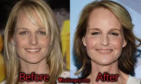 Although helen has not said anything for or against the rumors that she has undergone plastic surgery, these rumors did not become a thing . Helen Hunt Plastic Surgery Before And After Facelift Botox Pictures