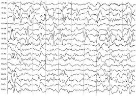 Image result for Infantile Spasms