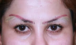 Tattoo removal involves the lightening and complete removal of tattoo ink with specific lasers. Traumatic Tattoo Removal
