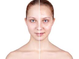 Eksfoliasi wajah untuk mengangkat sel kulit mati. Cara Menghilangkan Jerawat Dengan Photoshop Mudah Dan Cepat Hot Liputan6 Com