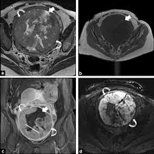 Image result for Leiomyosarcoma