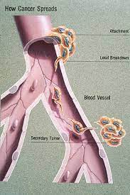 Peritoneal mesothelioma is the name given to the cancer that attacks the lining of the abdomen. Metastasis Wikipedia