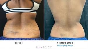 The device holds the part of your body your doctor wants to target between two paddles. Coolsculpting San Antonio Slimedica