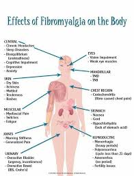 Effects Of Fibromyalgia On The Body Costochondritis Chronic Fatigue Fibromyalgia Symptoms