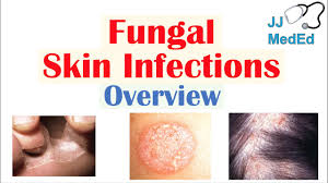 There are at least 100,000 species of fungi. Overview Of Fungal Skin Infections Tinea Infections Youtube
