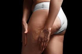 Sport ernährung creme schüssler salze wickel massage. Cellulite Eine Erfindung Der Industrie Brigitte De