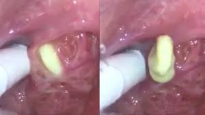 Check spelling or type a new query. Tonsil Stone Removal Youtube
